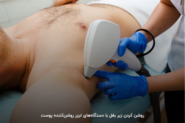 سیاهی زیر بغل عارضه‌ای بدون خطر است که اغلب افراد برای زیبایی بیشتر به دنبال رفع آن هستند. تکنیک‌های مختلفی برای رفع تیرگی زیر بغل وجود دارد که هدف همه آن‌ها یکسان است. 