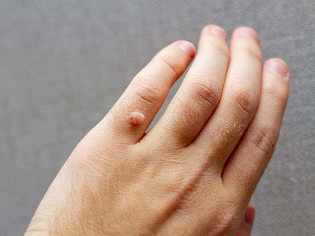 دست‌ها و انگشتان از عضوهای حساس بدن در برابر عفونت‌ها هستند. انواع مختلفی از زگیل‌ در این مناطق ممکن است ایجاد شود. خبر خوب آنکه، این عارضه اغلب خود به خود بهبود پیدا می‌کند، اما در برخی موارد بهبود آن طول می‌کشد یا آزاردهنده است.
