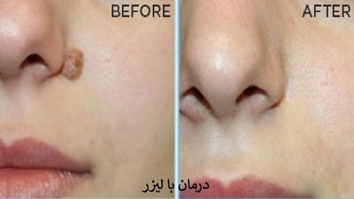 تمام زگیل‌ها در بدن توسط ویروس پاپیلومای انسانی (HPV) ایجاد می‌شوند. ایجاد این عارضه به خصوص در صورت ممکن است باعث نگرانی و عدم اعتمادبه‌نفس در فرد شود. خوشبختانه امروزه روش‌های زیادی برای درمان زگیل صورت وجود دارد؛ بنابراین نیازی نیست فرد به خاطر آن ناراحت باشد.