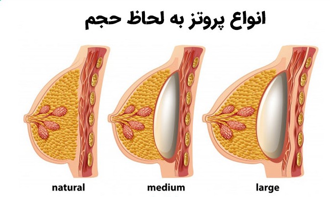 پروتز سینه، جزء عمل‌های زیبایی سینه به‌شمار می‌رود. در این جراحی، لیفت سینه و بزرگ شدن آن به‎وسیله حجم‌دهی به آن انجام می‎شود. جراحی زیبایی سینه زنان سبب حجیم و بزرگ شدن سینه یا جایگزین بخش‌هایی از سینه آنان می‌شود که به‎ دلایلی از دست رفته است.