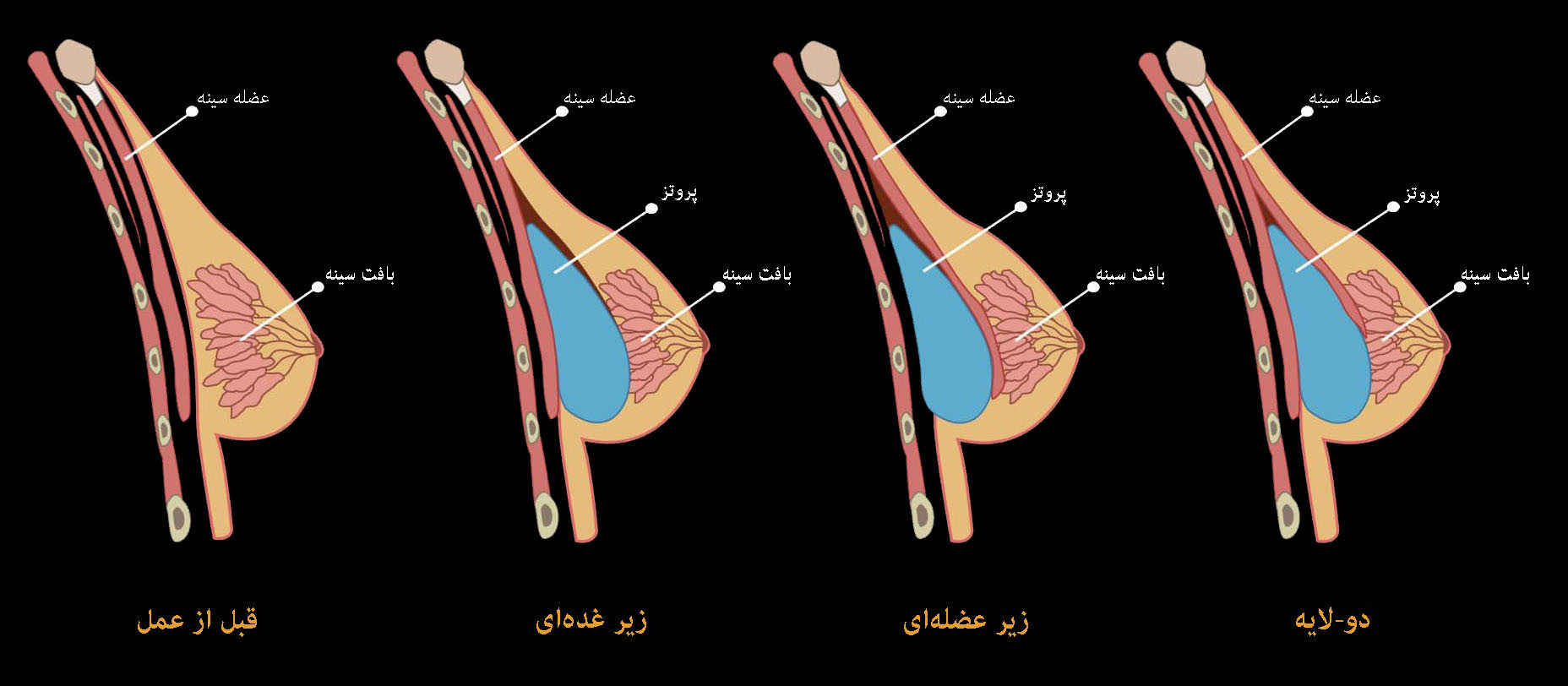 جراحی ترمیمی سینه یا ماموپلاستی: کاربرد، مراقبتها، هزینه