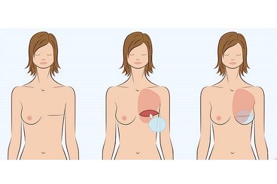 به عمل جراحی زیبایی سینه در اصطلاح پزشکی در انگلیسی Mamoplasty گفته می‌شود. این جراحی زیبایی اگر به ‌منظور کوچک کردن اندازه سینه‌ها باشد  به مامو پلاستی کاهشی یا کاهندهReduction Mamoplasty و اگر به‌منظور بزرگ کردن سینه‌ها باشد، به مامو پلاستی افزایشی یا افزاینده augmentation mammoplasty معروف است.