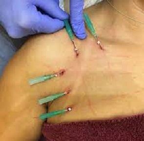 در انگلیسی به لیفت سینه با نخ یا «ترد لیفت»، Breast lift with threads یا Breast Lifting with Threads یا Thread breast lift نیز گفته می‌شود که در دسته روش‌های لیفت سینه به روش غیرجراحی non surgical breast lift قرار می‌گیرد.
