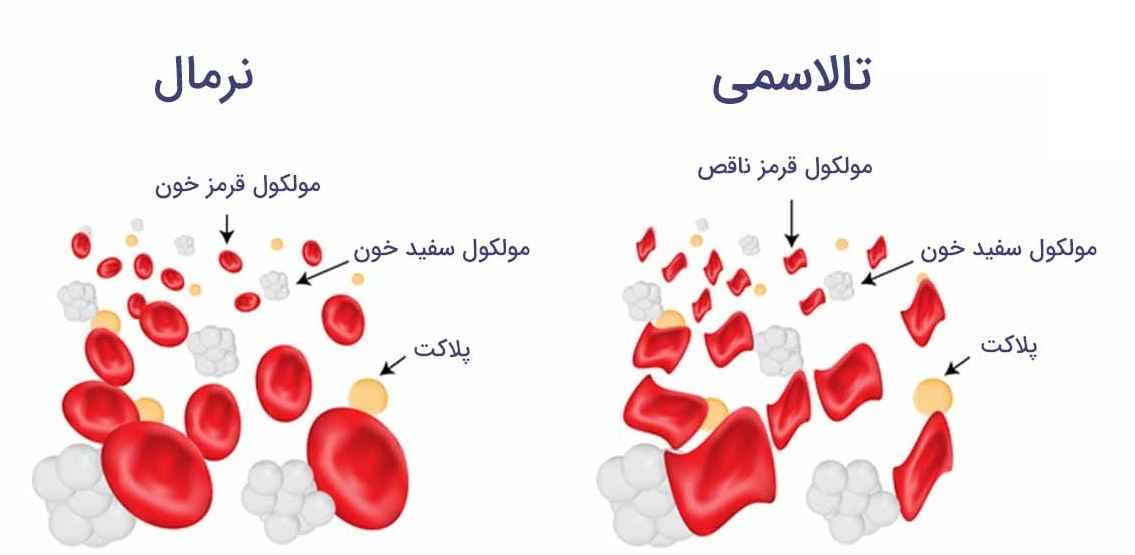 تفاوت کم خونی و تالاسمی چیست