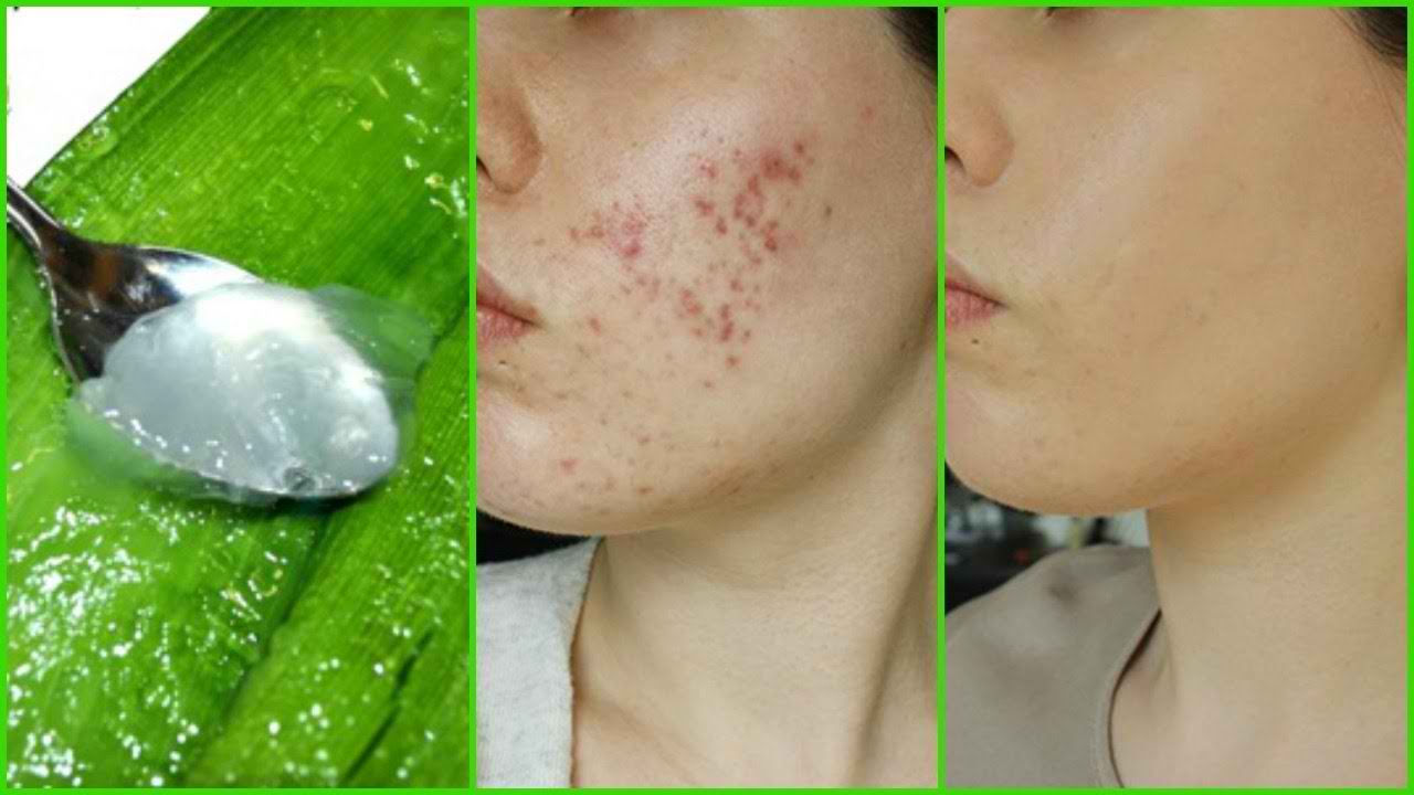 ماسک های خانگی یکی از روش‌های موثر و کم هزینه برای درمان جوش صورت چرب هستند. ماسک های خانگی حاوی مواد طبیعی هستند که به پاکسازی پوست، کاهش چربی پوست و درمان جوش صورت کمک می‌کنند.