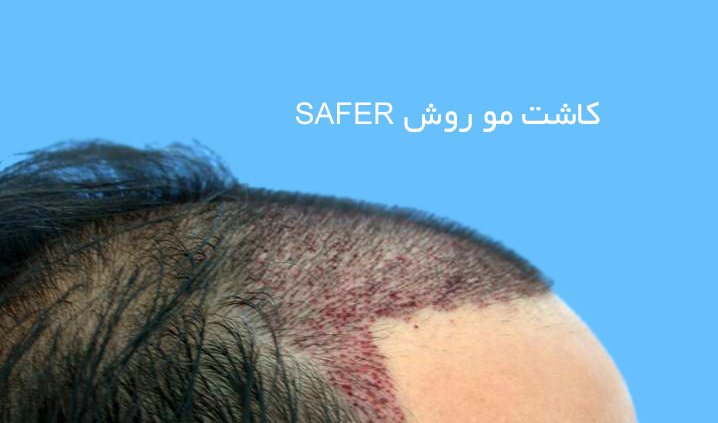 کاشت مو به روش سیفر safer