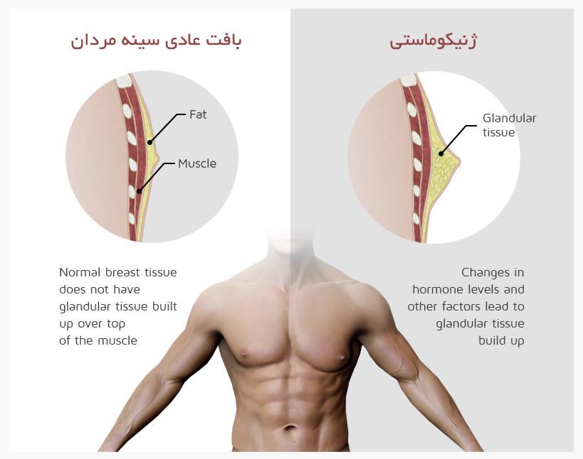 درمان خانگی ژنیکوماستی