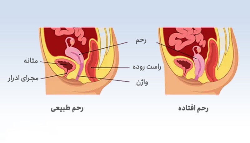 افتادگی واژن، یک عارضه مربوط به اندام زنانگی است. در این عارضه، به علل مختلف ماهیچه‌هایی که از اندام‌های لگنی زنان حفاظت می‌کنند، ضعیف شده و باعث می‌شوند رحم، مجرای ادرار، مثانه یا روده بزرگ به داخل واژن فرو رود.