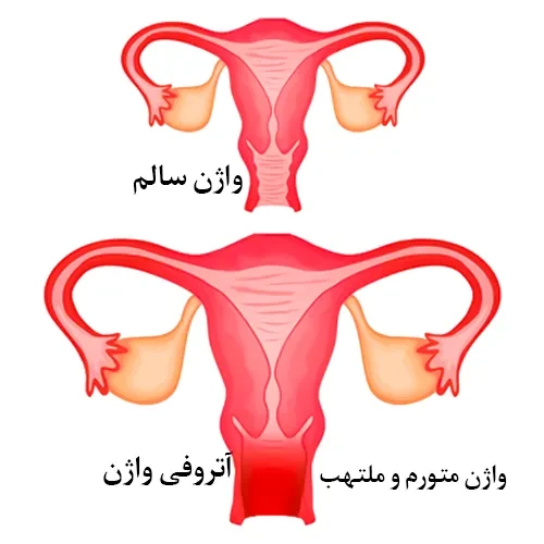 تغییرات هورمونی بر اثر عوامل گوناگون، به‌‌ویژه افزایش سن، سبب کاهش ترشح استروژن در بدن می‌شود که این موضوع روی غلظت رطوبت واژن اثرگذار است. بافت واژن بدون ترشح استروژن، نازک و خشک می‌شود و خاصیت کشسانی خود را از دست می‌دهد و در معرض آسیب قرار می‌گیرد.