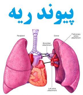 پیوند ریه، یک روش جراحی پیچیده و حیاتی است که در آن ریه‌های آسیب‌دیده بیمار با ریه‌های سالم جایگزین می‌شوند. این‌روش درمانی برای بیماران مبتلا به بیماری‌های مزمن و شدید ریوی، مانند فیبروز کیستی، بیماری مزمن انسدادی ریه (COPD) و فیبروز ریوی که دیگر روش‌های درمانی قادر به بهبود وضعیت آنان نیست، انجام می‌شود. 
