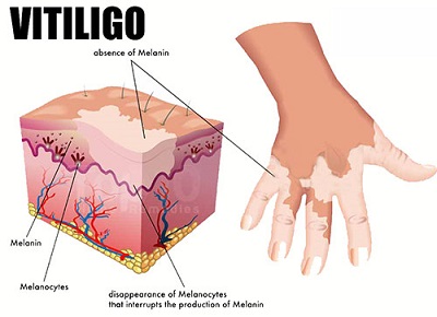 بیماری پوستی برص به انگلیسی Vitiligo نامیده می‌شود. در این بیماری، لکه‌های سفیدی روی پوست بروز می‌کند. هر مکانی روی بدن می‌تواند آسیب ببیند، به همین خاطر بیشتر افراد مبتلا به ویتیلیگو، در بیشتر نواحی بدنشان، لکه‌های سفید دارند.