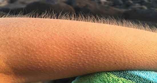 در انگلیسی به عارضه پوست مرغی، Chicken skin گفته می‌شود، اما در اصطلاح پزشکی این عارضه به کراتوزیس پیلاریس (Keratosis Pilaris) معروف است که نوعی اختلال پوستی خوش‌‌خیم به‌شمار می‌رود.