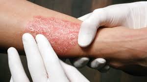 قاتل پسوریازیس