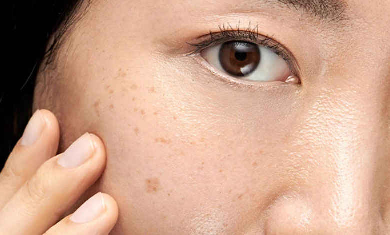سریع ترین راه از بین بردن لک صورت