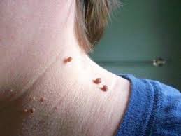 زگیل گوشتی یک عارضه پوستی شایع است که می‌تواند در هر نقطه‌ای از بدن، از جمله صورت، گردن، زیر بغل، کشاله ران و کف دست و پا ایجاد شود. زگیل گوشتی معمولاً به رنگ پوست یا کمی تیره‌تر است