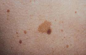 لکه های روی پوست یک مشکل شایع است که می تواند در هر سنی رخ دهد. این لکه ها ممکن است در هر قسمتی از بدن ظاهر شوند و معمولاً قهوه ای یا سیاه هستند. با مجله سلامت پلاس همراه باشید تا دلایل لکه های ناگهانی روی پوست را بدانید.