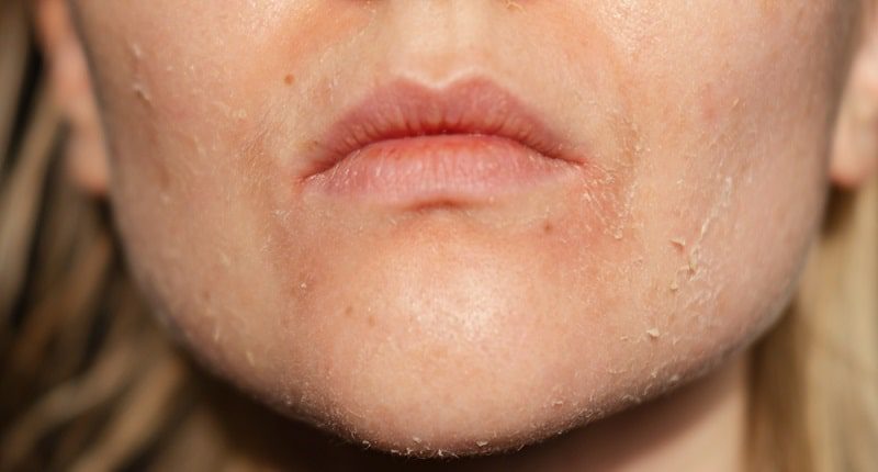 اگزما در فصل سرما