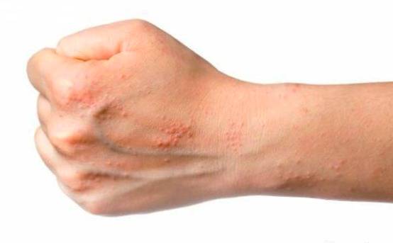 با اگزمای زمستانی چه کنیم