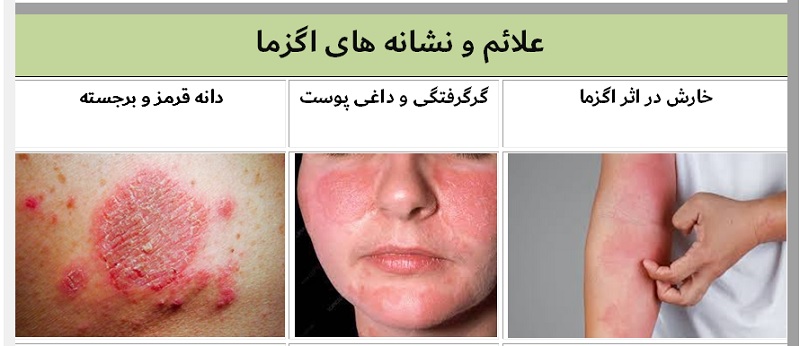  اگزما در هر زمانی از سال می‌تواند روی بدهد اما فصل زمستان می‌تواند موجب تشدید علائم اگزما شده و دردسرهایی ایجاد کند. اگزما یا درماتیت آتوپیک یک بیماری مزمن پوستی است. 