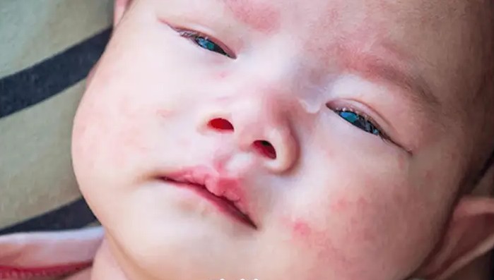 درمان خانگی جوش زدن صورت نوزاد