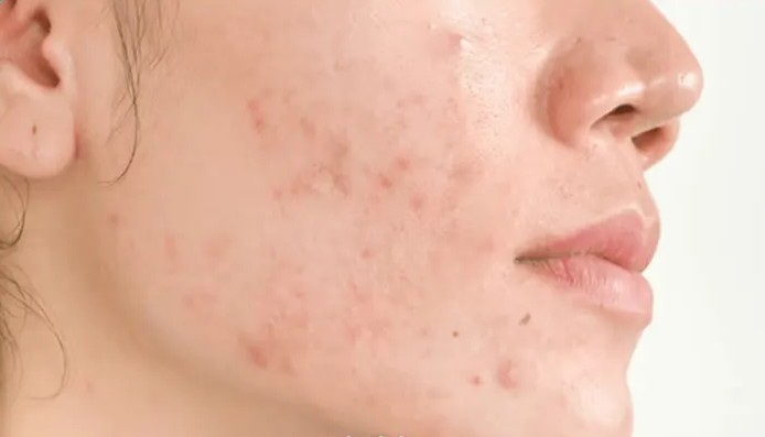 مصرف قرص ترانگزامیک اسید برای لک صورت