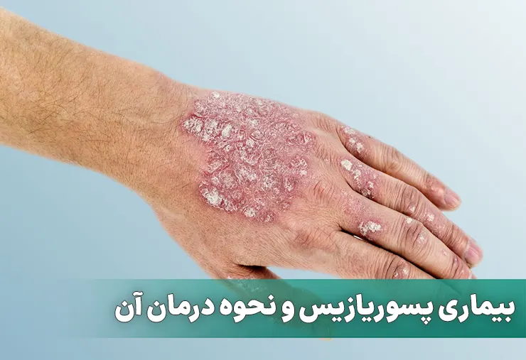 مصرف سیکلوسپورین برای پسوریازیس