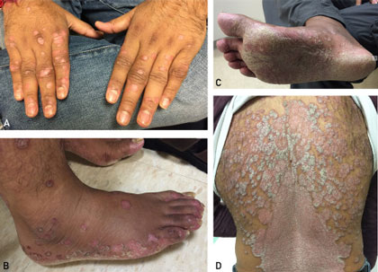 ویروس چیکونگونیا (Chikungunya) از طریق نیش پشه، انسان را آلوده می‌کند و باعث تب و درد مفاصل می‌شود. این ویروس به‌ندرت کشنده است، اما نوع حاد آن می‌تواند بدن فرد را برای زمان طولانی تحت تاثیر قرار دهد و علائم درد در او باقی بماند. در حال حاضر هیچ درمان و واکسن خاصی برای این ویروس وجود ندارد، و فقط باید به فکر راه های پیشگیری از چیکونگونیا باشید.