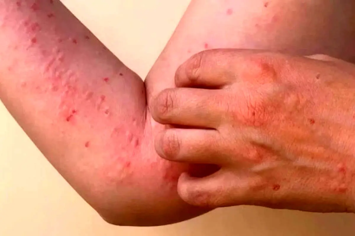 ویروس چیکونگونیا